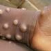 Epidémie de «Monkeypox» une nouvelle pandémie est-elle possible ?