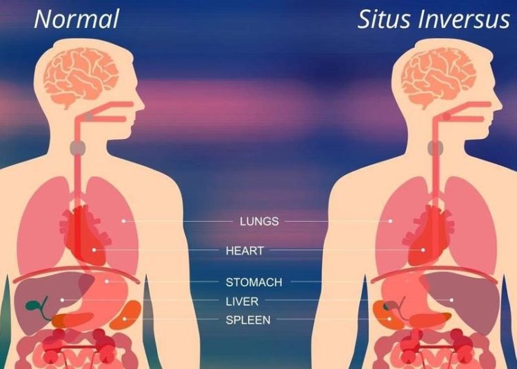 À Al Hoceima, une jeune fille mène une vie normale avec des organes inversés