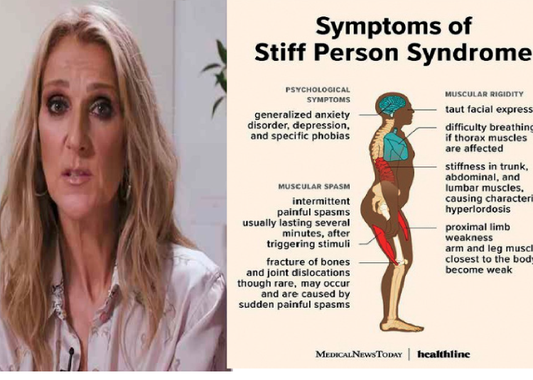 La maladie rare de CELINE DION :  c&rsquo;est quoi Stiff-Person Syndrome ( le syndrome de la personne raide ) ?