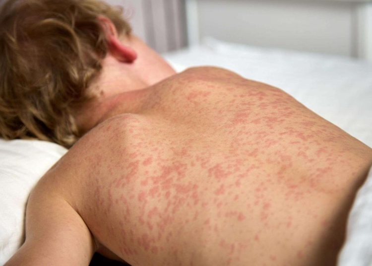 Les contaminations de la « Rougeole » augmentent en France avec 13 cas d’enfants