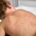 Les contaminations de la « Rougeole » augmentent en France avec 13 cas d’enfants